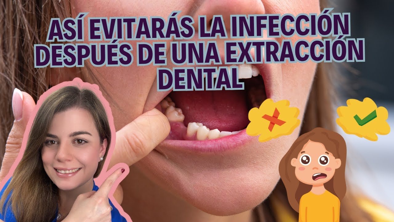 Qué hacer después de una EXTRACCIÓN DENTAL en 2024 ✅