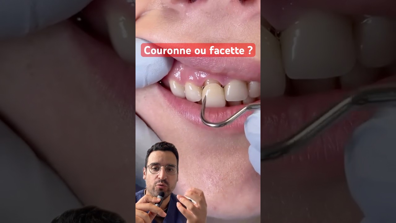 Facette ou couronne : quelle diff&eacute;rence, et laquelle choisir ?