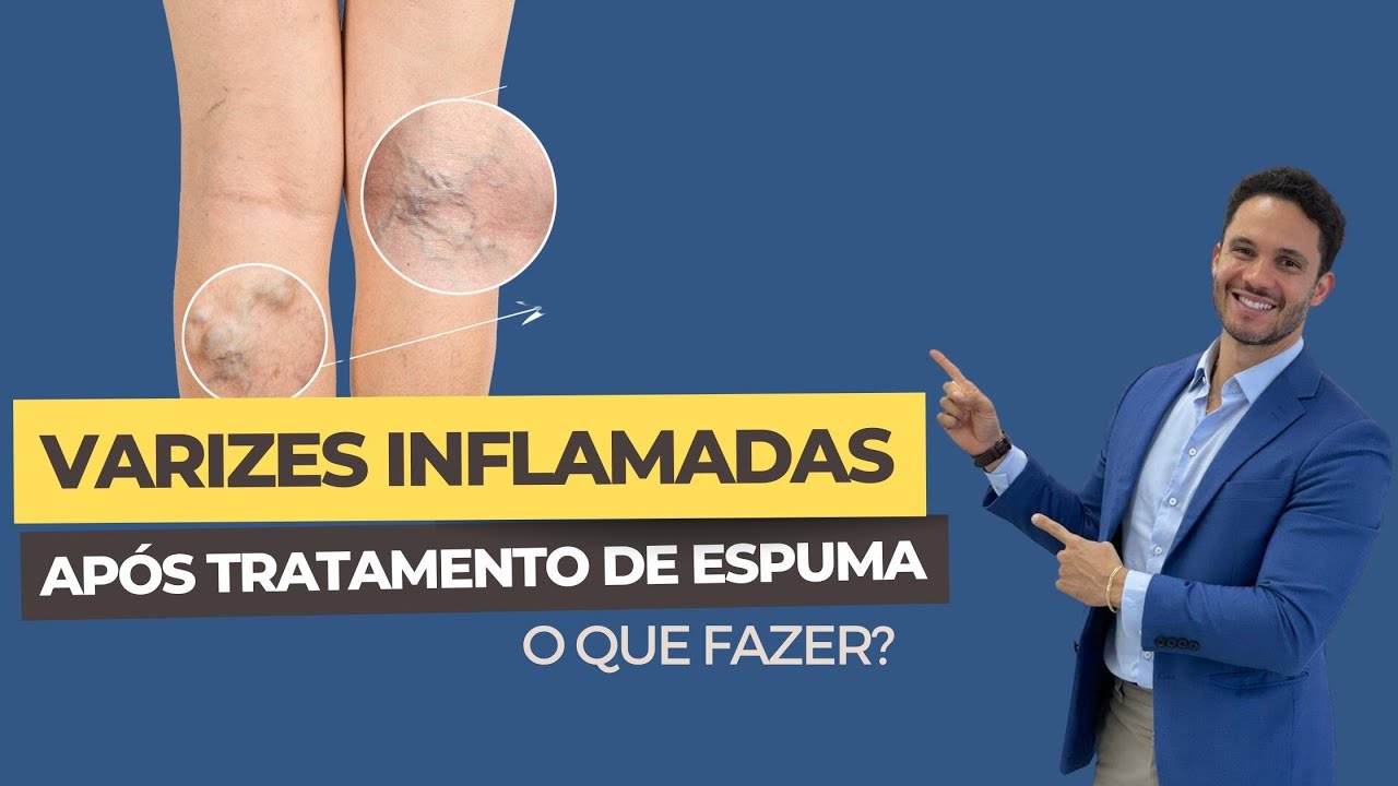 Varizes inflamadas após tratamento com espuma: o que fazer?