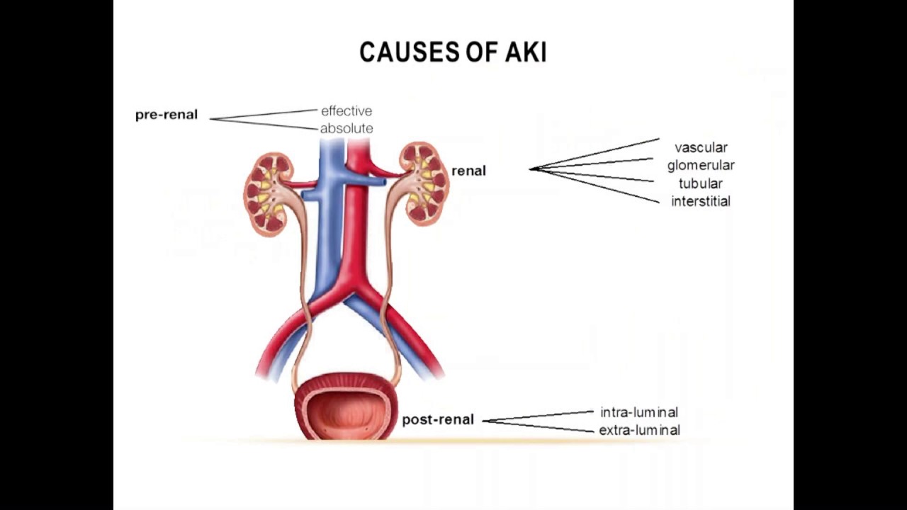 Acute Kidney Injury - A Primer for Primary Care Physicians (Nov 2016)