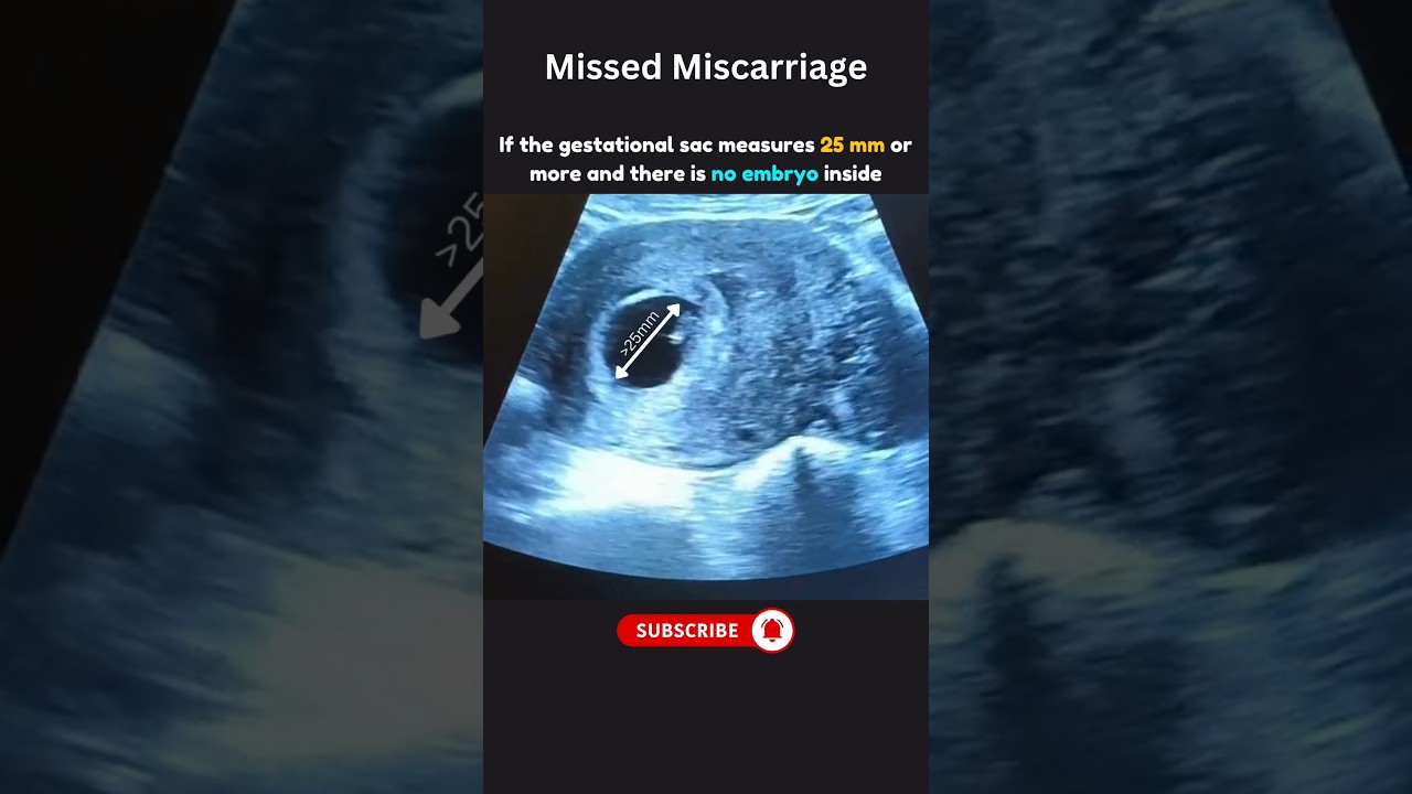 No Heartbeat  on Your First Pregnancy Scan? Watch this 