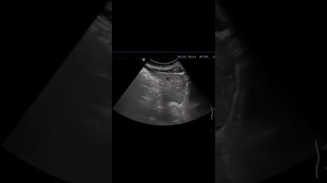 simple liver cyst ✨