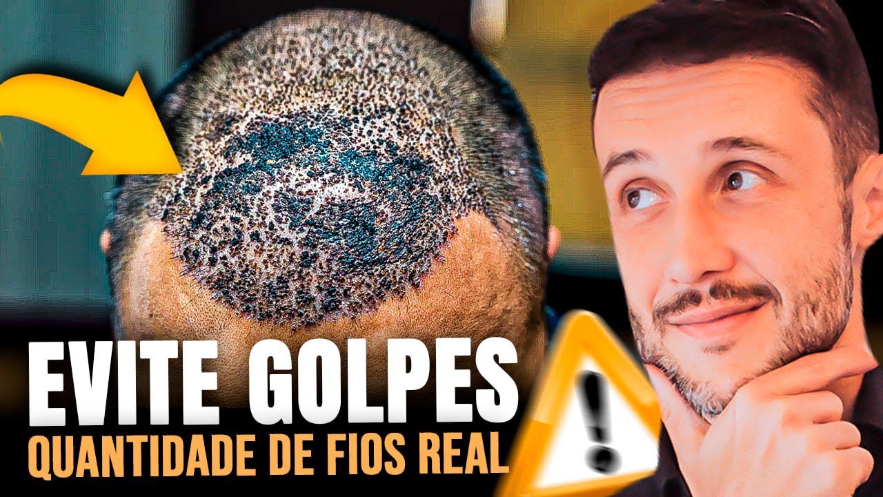 Transplante Capilar: Entenda a Quantidade de Fios Necessária e Evite Enganos