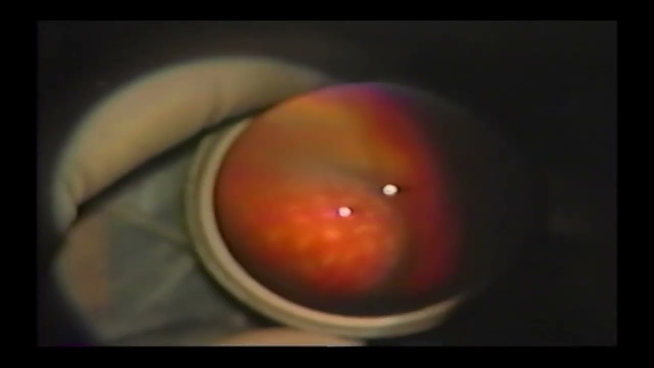 Laser retinopexy prevents retinal detachment  &ndash; Video S1 [537281]