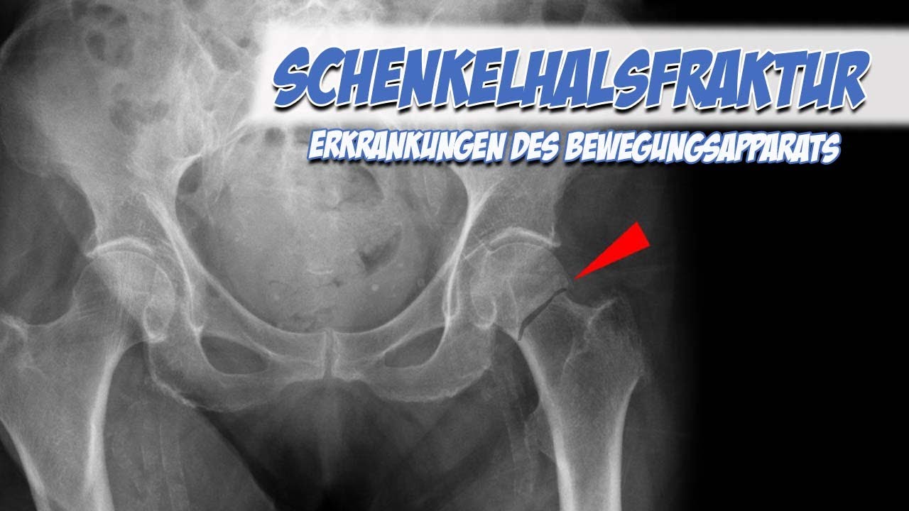 Schenkelhalsfraktur | Krankheitslehre | Pflege Kanal