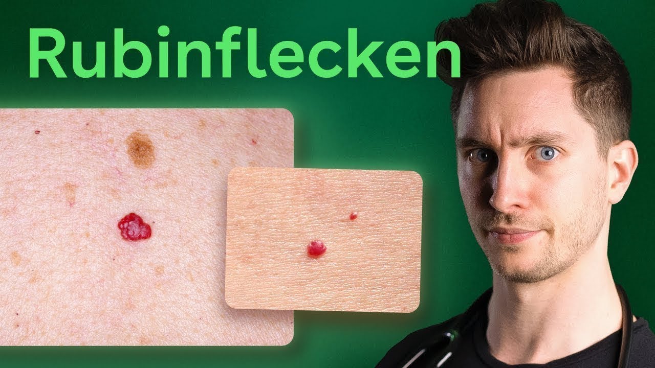 Rote Punkte auf der Haut: Sind Rubinflecken gef&auml;hrlich?