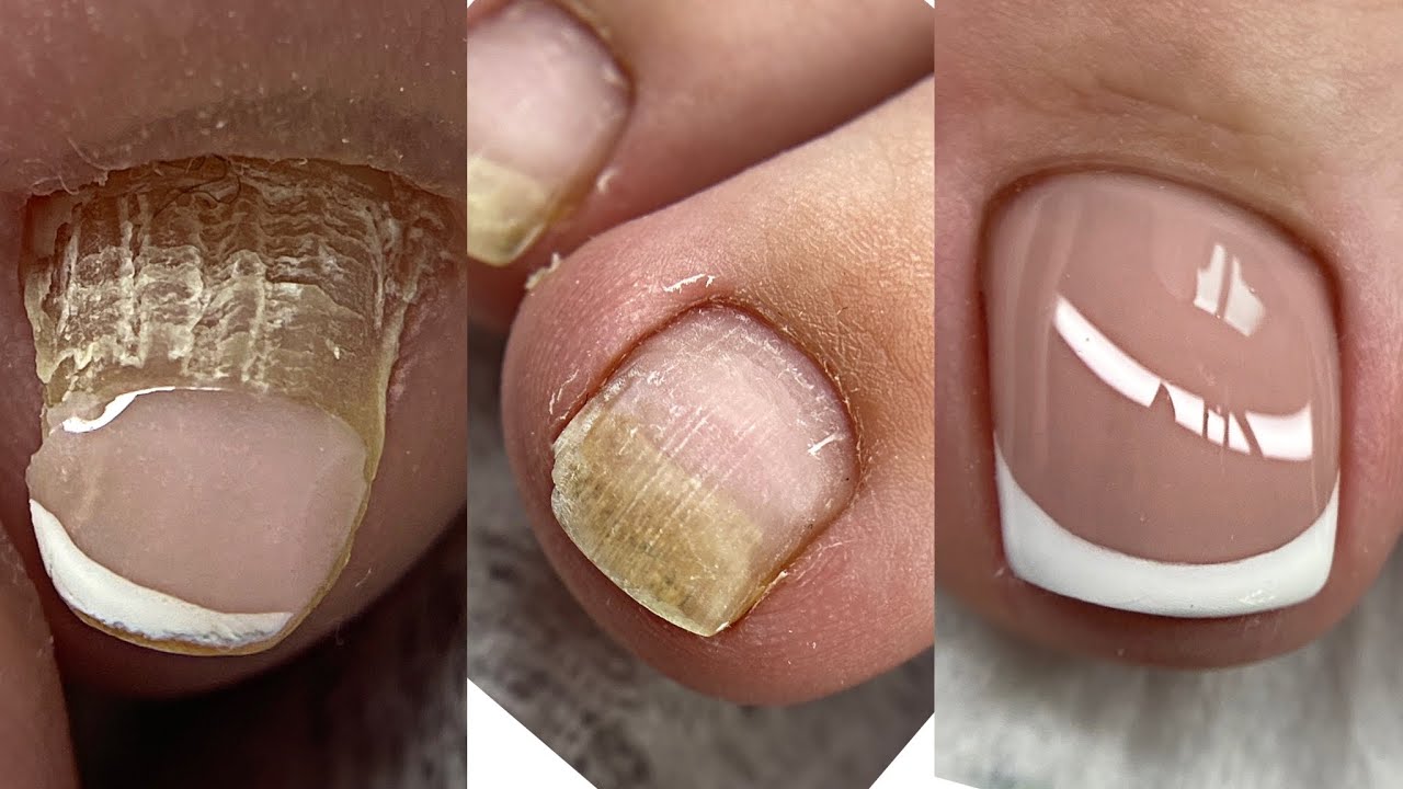 Удаляем подногтевую мозоль за 1 мин💅Педикюр на влажные ножки💅Лайфхаки для мастеров маникюра💅Френч