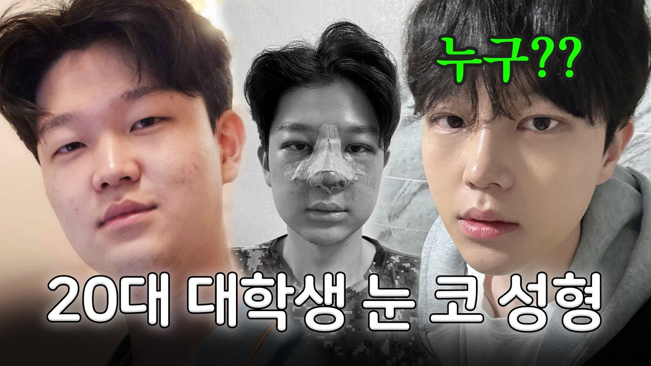 남자 눈 코 수술 후 역대급 전후 차이! 수술 한달차 영상 있음 [은호1Vlog]