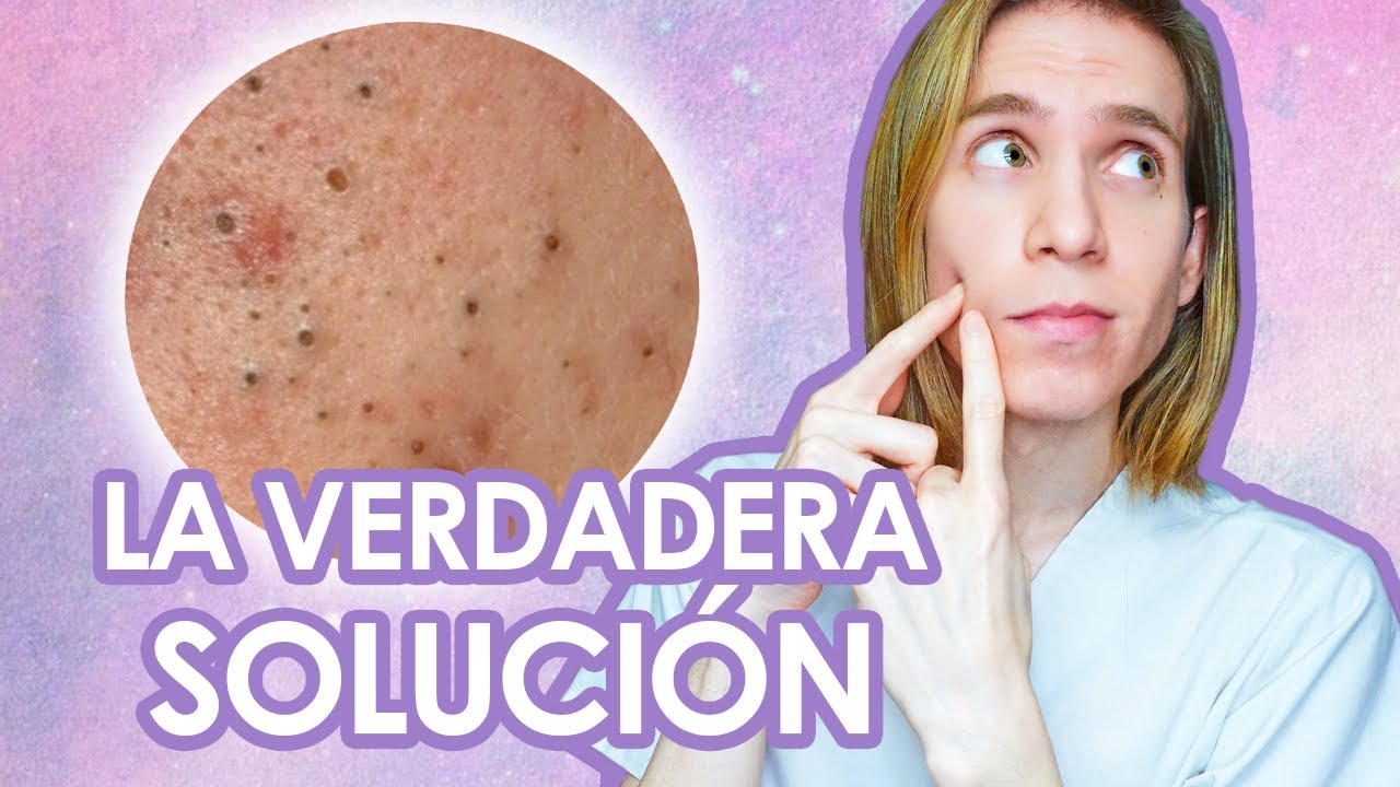 PUNTOS NEGROS: Como tratar y prevenir los comedones abiertos - Recomendaciones de un dermatologo