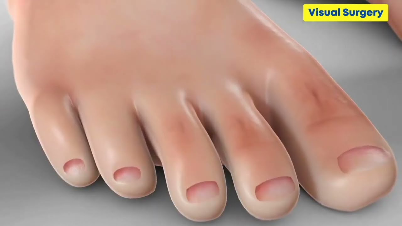 Névrome de Morton du pied et orteils - Chirurgie - Dr Simon Tournemine