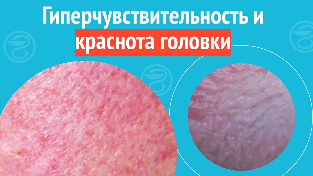 😡 Гиперчувствительность и краснота головки. Клинический случай №1320