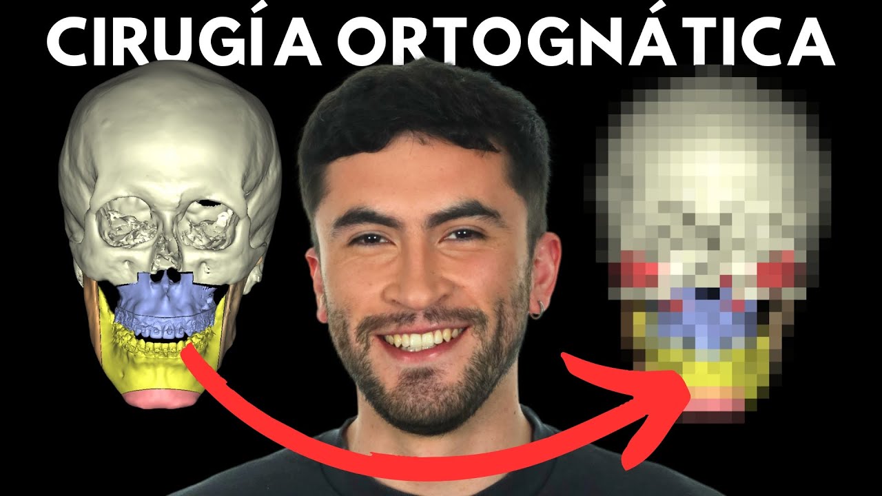 Clase III, Prótesis faciales y Cirugía Ortognática: Increíble Resultado