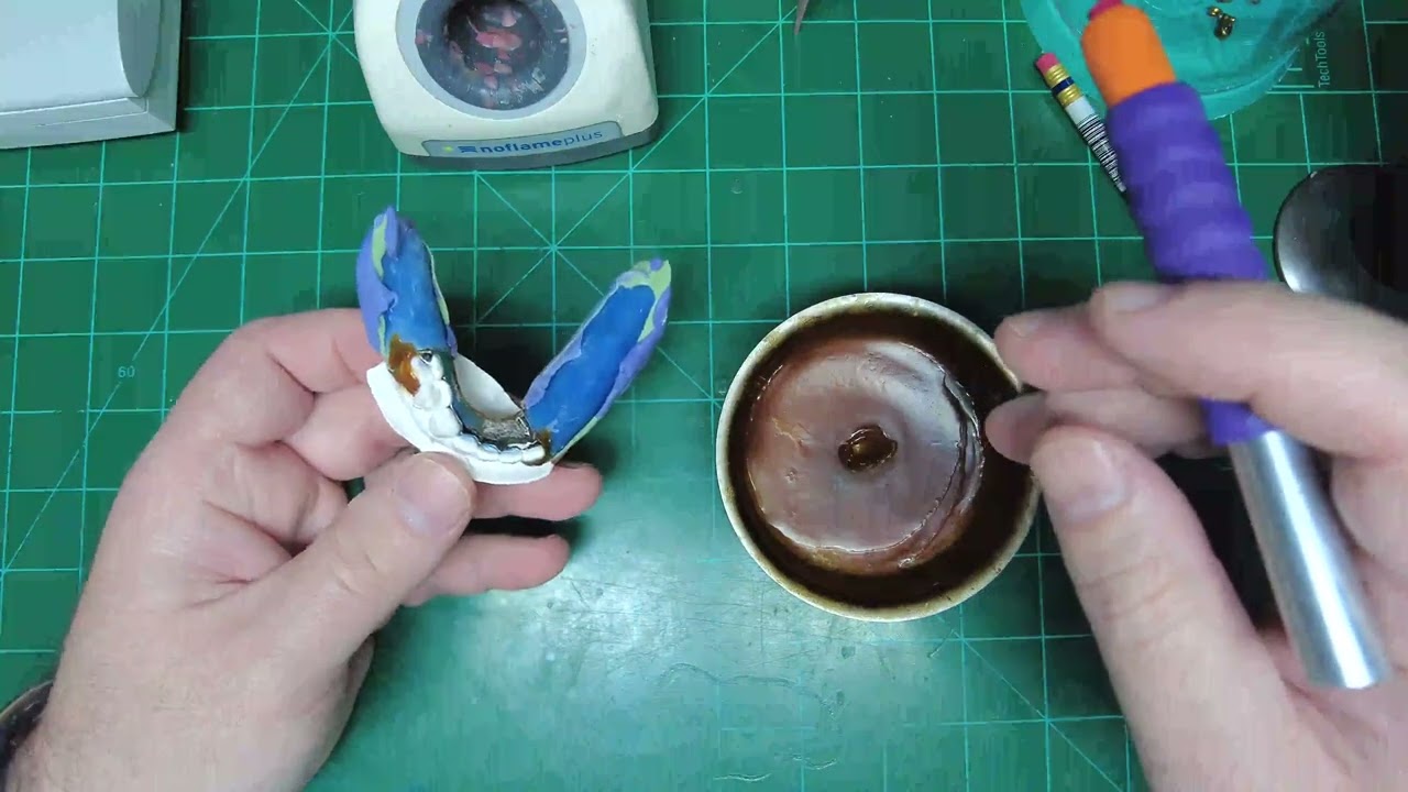 ALTERED CAST TECHNIQUE FOR RPD