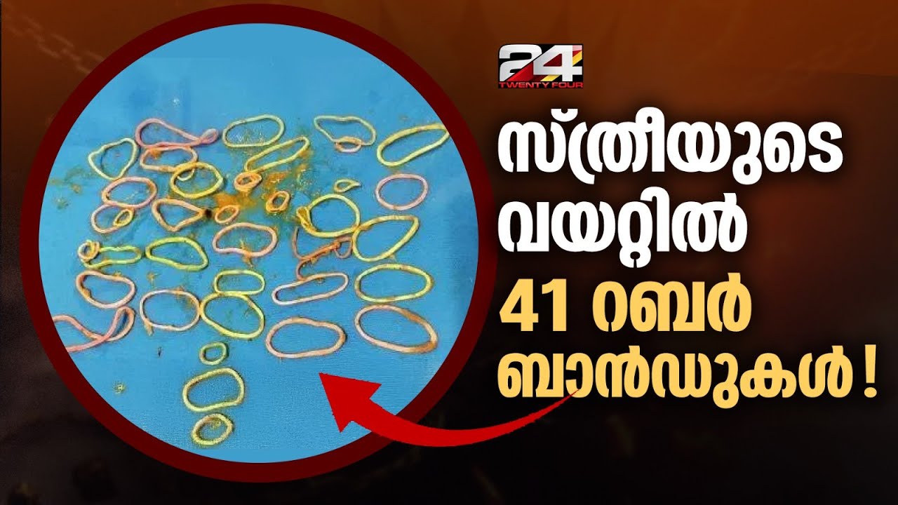 വയറുവേദനക്ക് ശസ്ത്രക്രിയ, സ്ത്രീയുടെ വയറ്റില്‍ കണ്ടെത്തിയത് 41 റബര്‍ ബാന്‍ഡുകള്‍ ! | Trivandrum