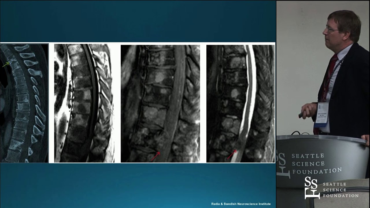Neuroradiology of Spinal Tumors - Hannu Huhdanpaa, MD, MSc