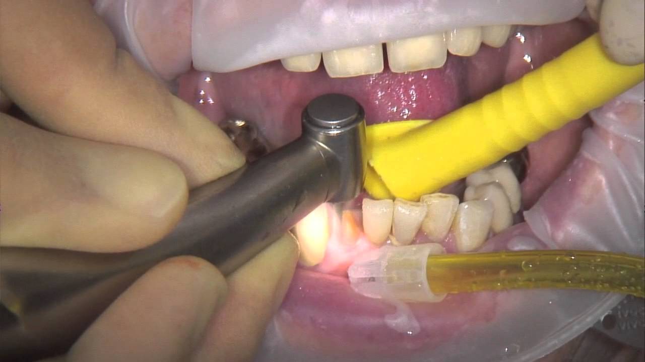 Bausch Fleximeter-Strips