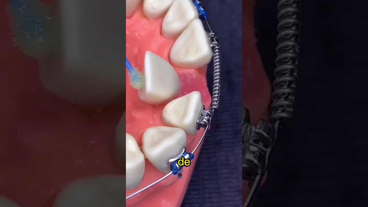 Dientes que salen por detrás de otros. Solución para dientes muy apiñados o juntos