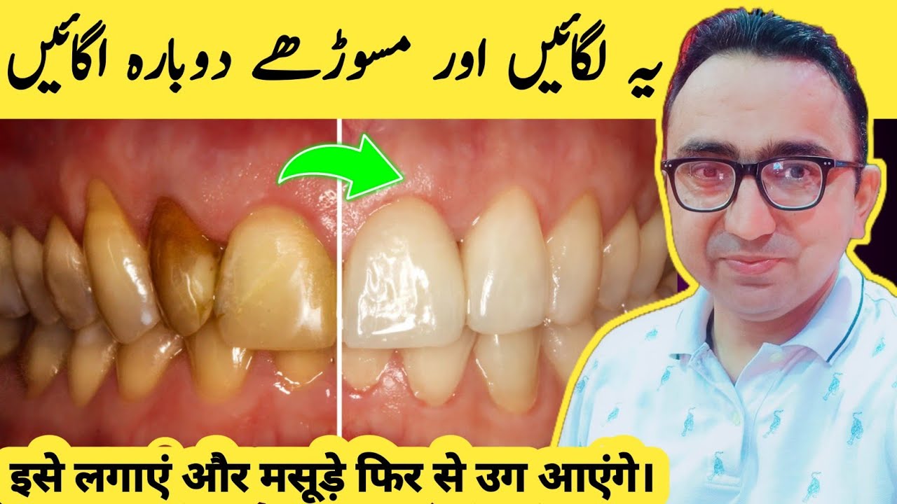 7 Secrets To Regrow Receding Gums Fast!