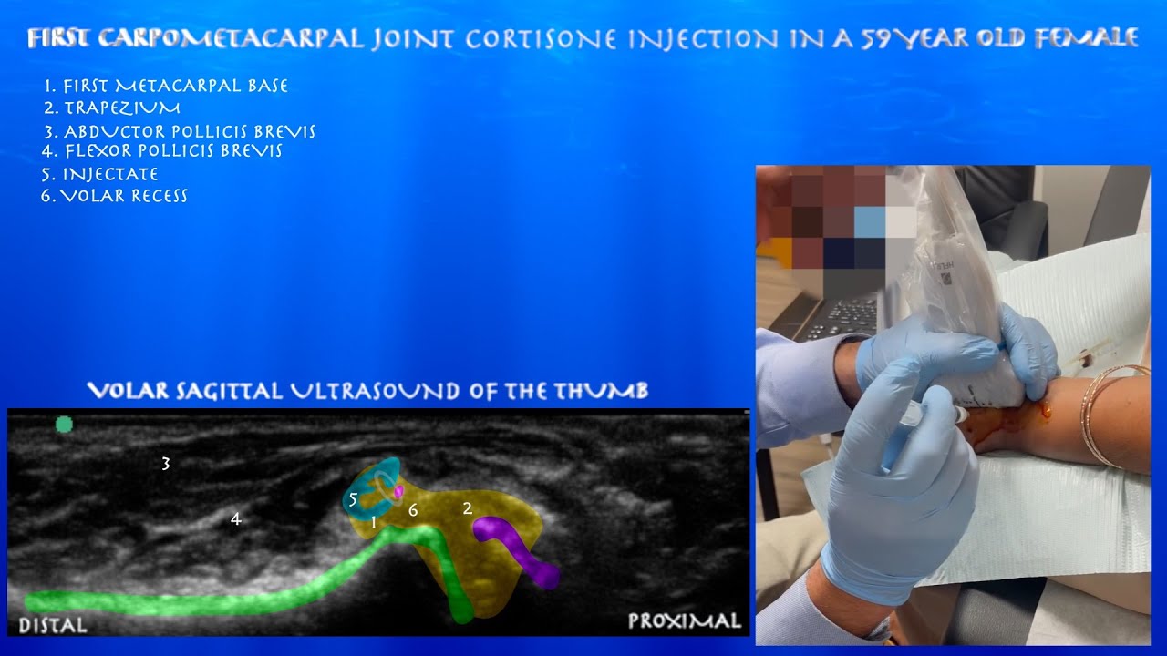 Ultrasound Guided Carpometacarpal Joint Injection in a 59 Year Old Female by probeultrasound
