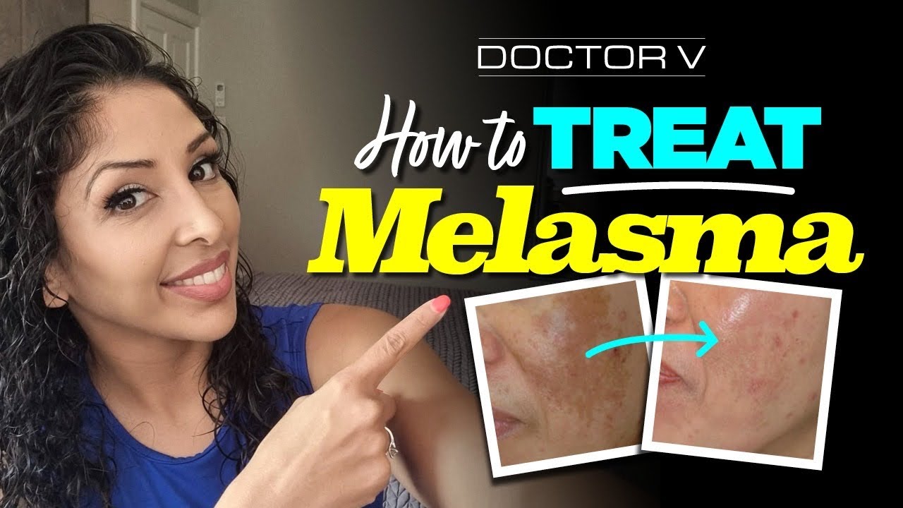 Doctor V - How To Treat Melasma | Skin Of Colour | Brown Or Black Skin