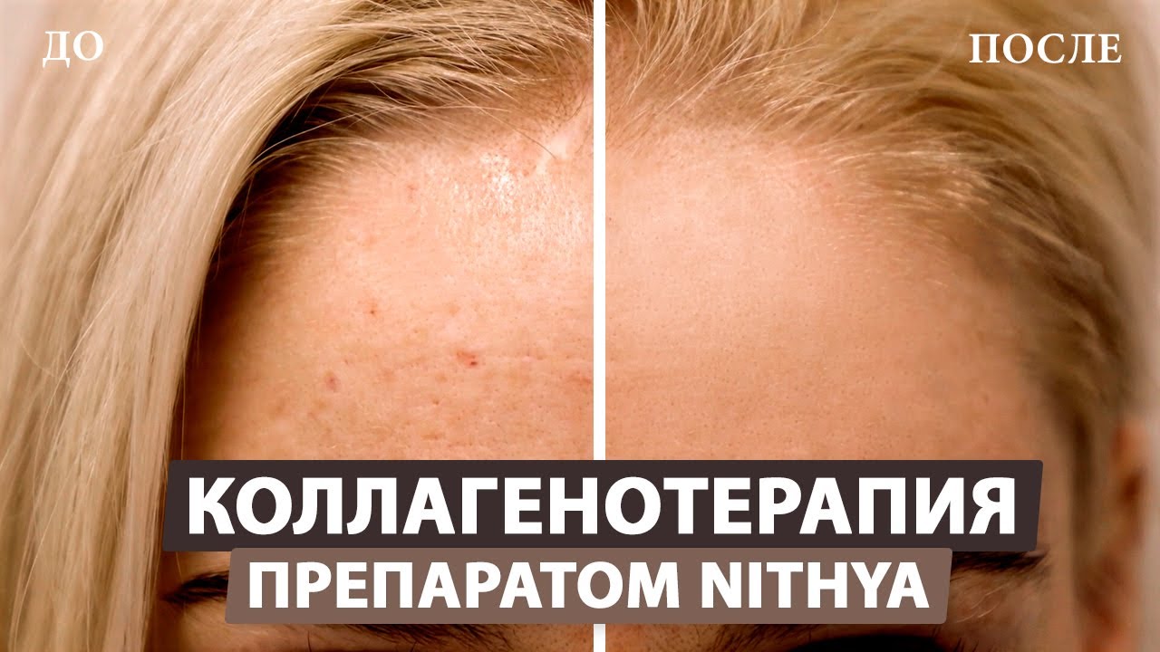 Улучшаем качество кожи лица с помощью коллагена «Nithya» (Нития)