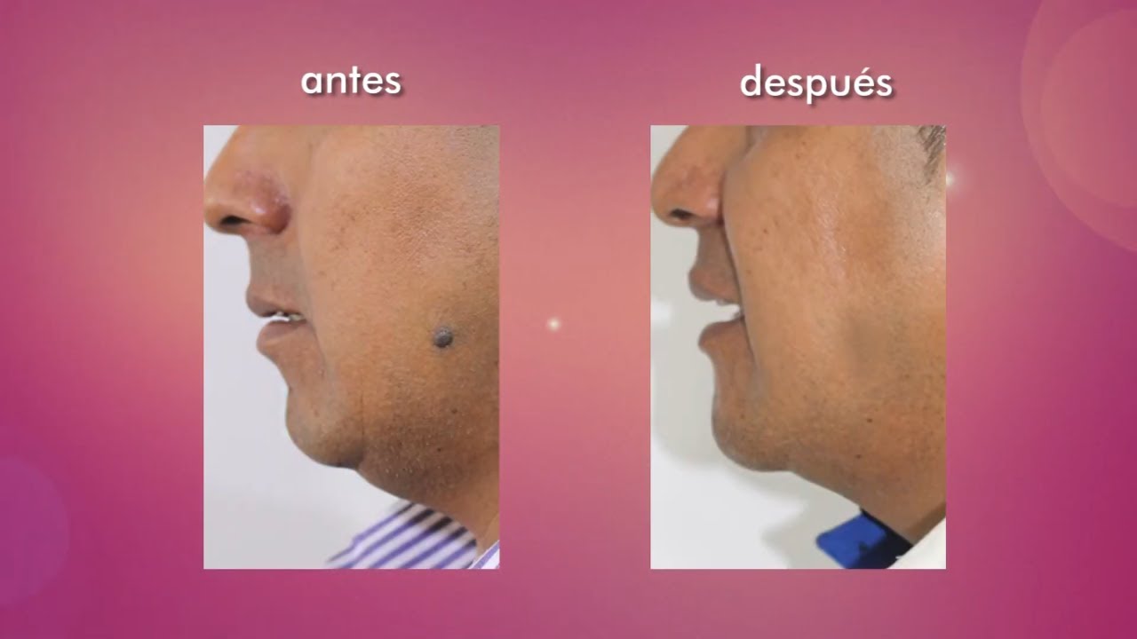 PERFILAMIENTO de ROSTRO 🧑‍🦰 BLEFAROPLASTÍA + MENTOPLASTÍA🤩 Dr PERCY NEVADO ALBÁN
