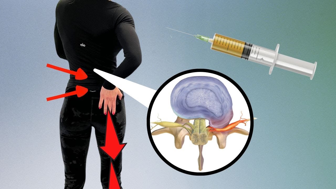 PRP Epidural For Radiculopathy | What Is The Evidence?