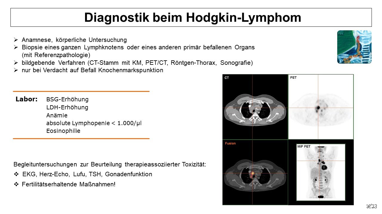 Diagnostik beim Hodgkin Lymphom | Strahlentherapie Prof. Hilke Vorwerk