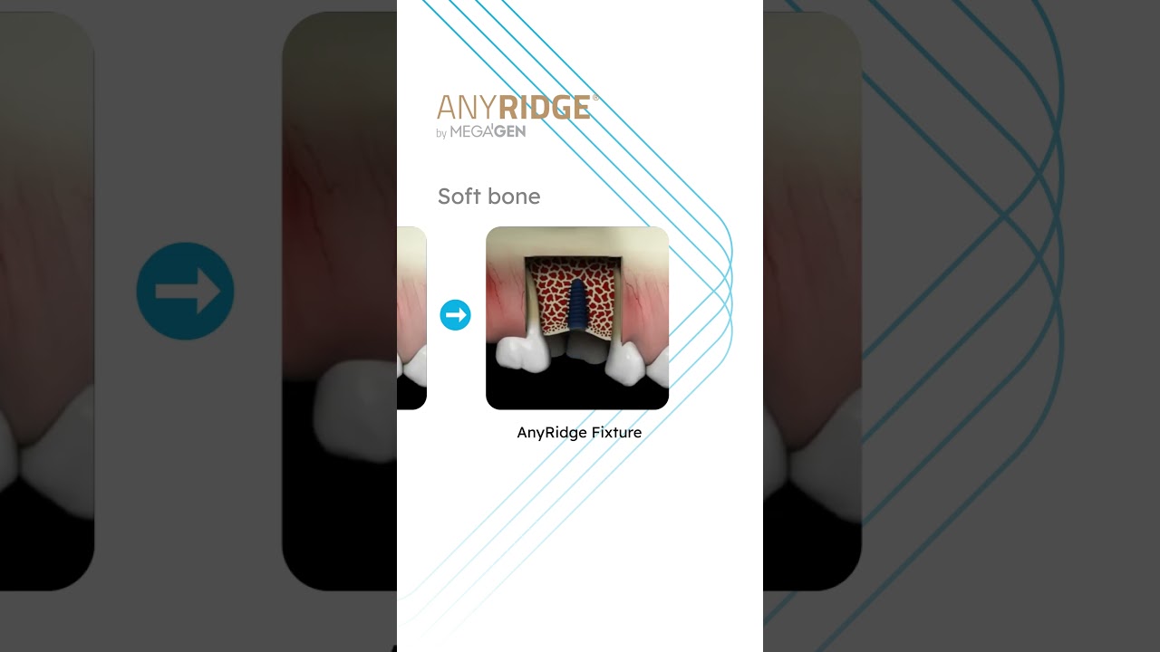 ANYRIDGE&reg; Drilling Sequence ▶️