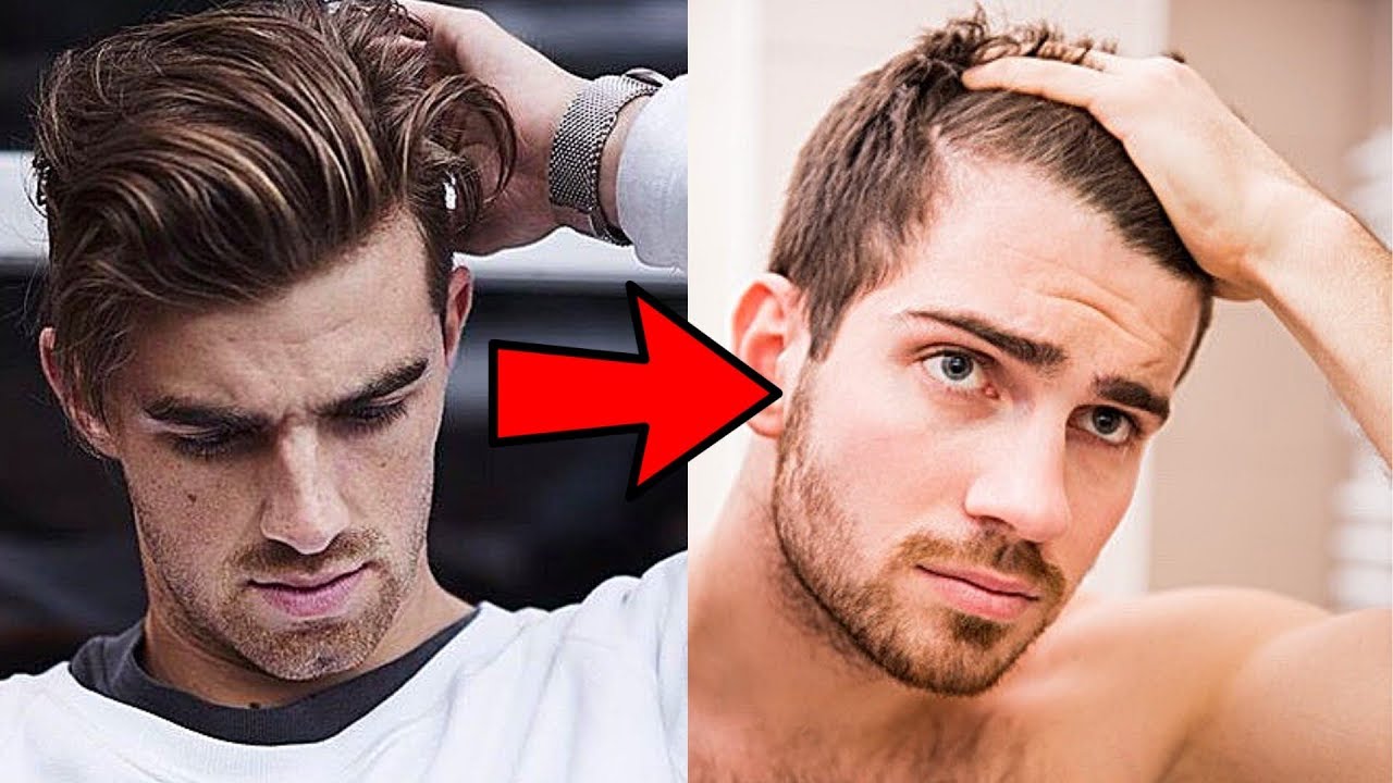 Male Pattern Baldness (Permanent) Vs Shedding (Temporary)