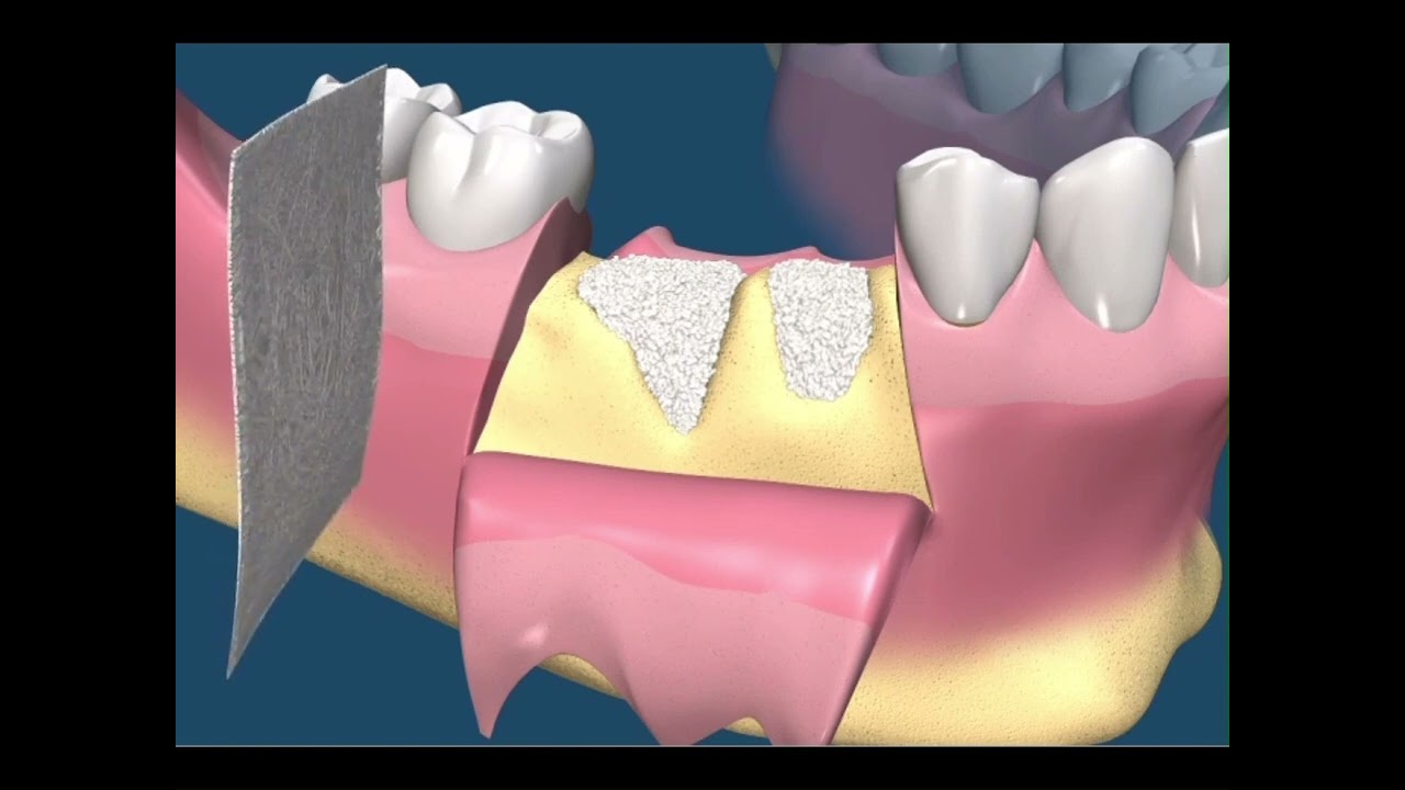 Preservazione Cresta Ossea: La Tecnica per Non Perdere Osso Dopo l'Estrazione (Animazione 3D)