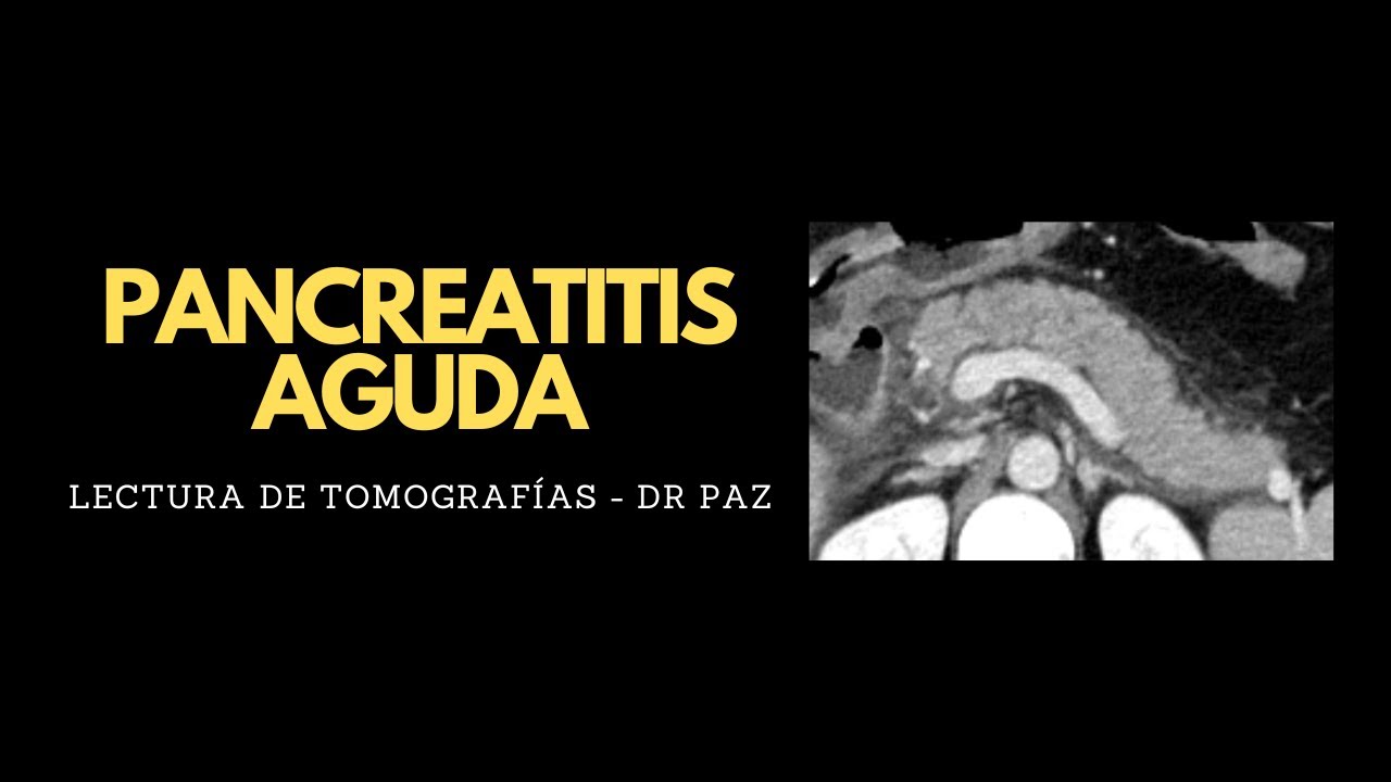 Lectura de tomografías - Pancreatitis aguda por coledocolitiasis?