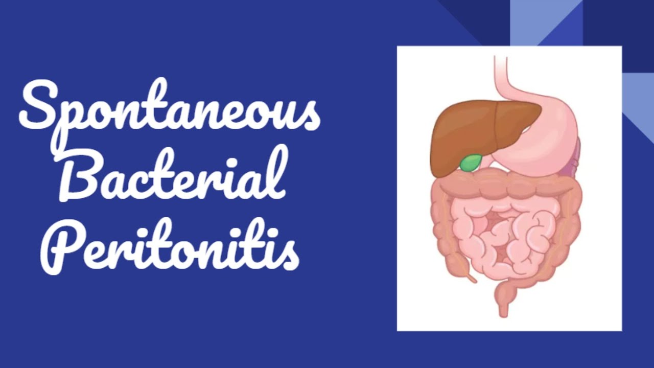 Spontaneous Bacterial Peritonitis (SBP): Causes, Diagnosis, Treatment, and Prevention