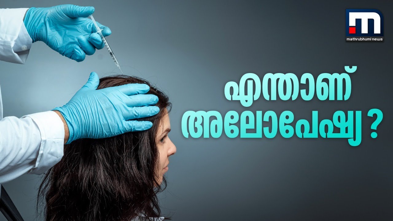 എന്താണ് 'അലോപേഷ്യ ഏരിയറ്റ'? - ഡോക്ടറോട് ചോദിക്കാം | Alopecia Areata | Hair Fall |   Disease | Doctor