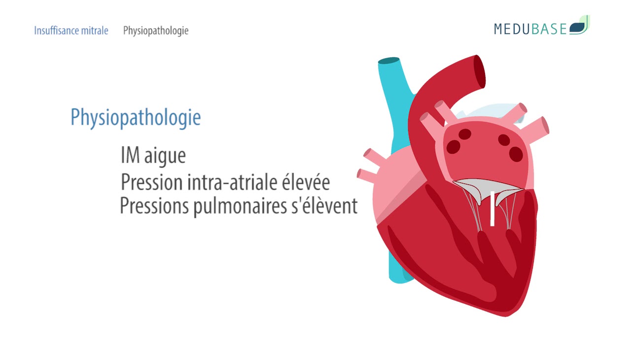 Insuffisance mitrale | Medubase.com