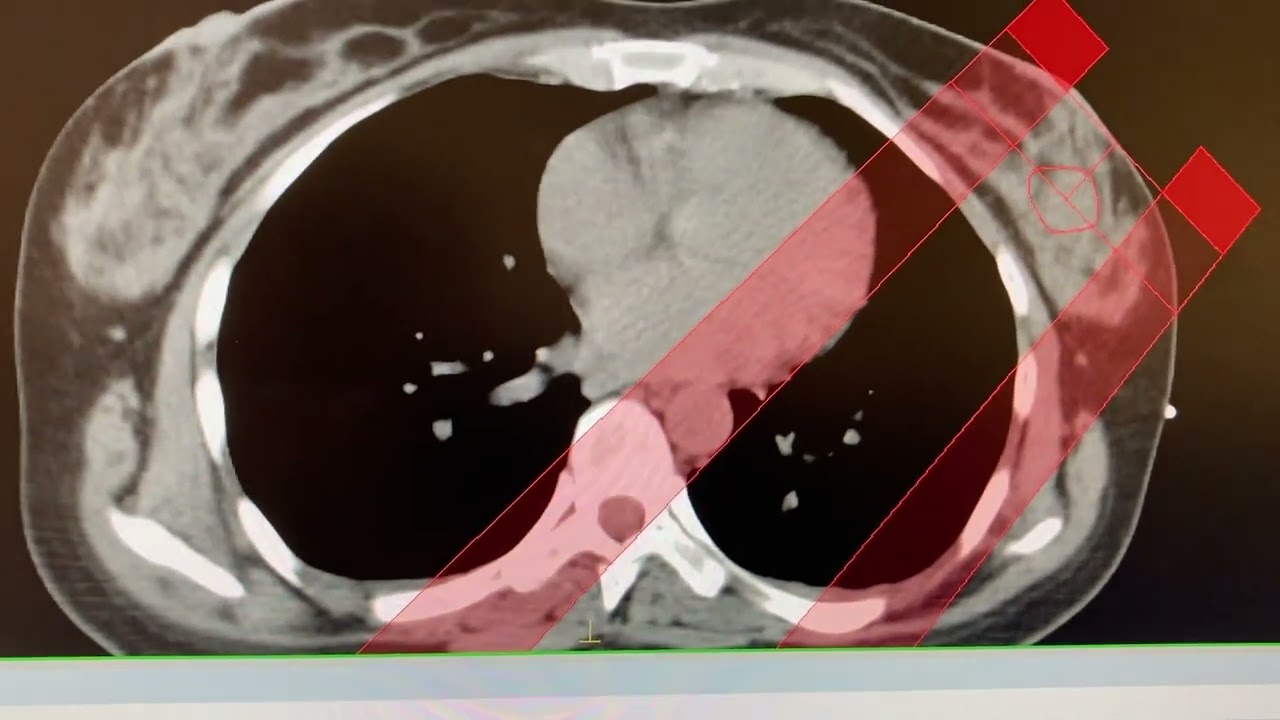 Breast Cancer Treatment Planning: Creating DVH in Monaco