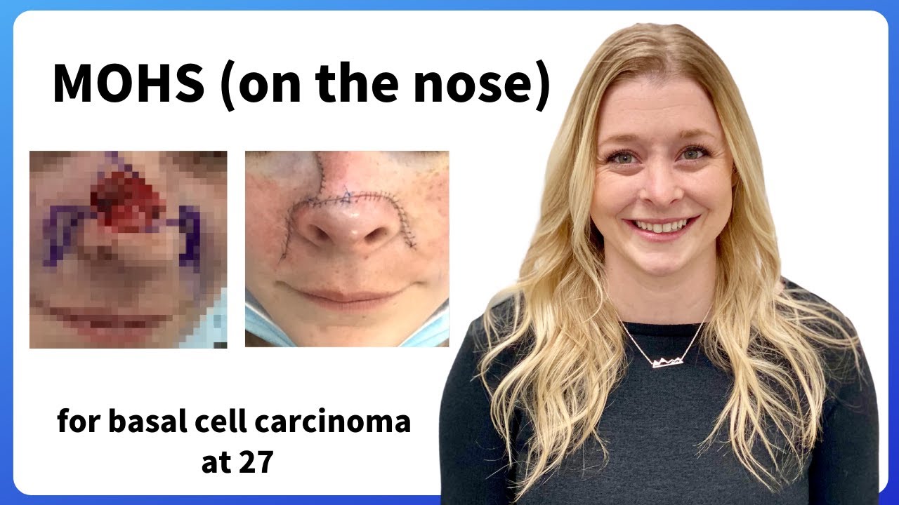 Basal Cell Carcinoma and MOHS (on the nose) at 27 in Boise 2021