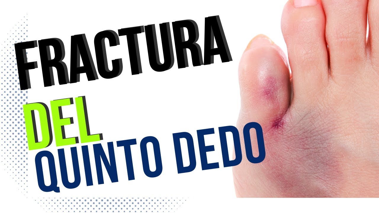 DEDO MEÑIQUE DEL PIE ROTO #doctorjuancarlosalbornoz #dedomeñiquedelpie