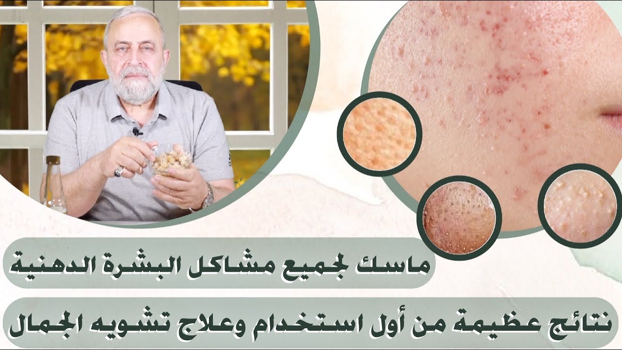 نفذي هذا الماسك لجميع مشاكل البشرة الدهنية | نتائج عظيمه من اول استخدام وعلاج لسحر تشويه الجمال