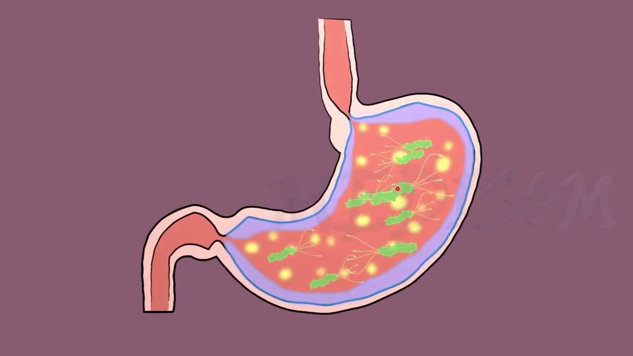 AF SOMALI HELICOBACTER PYLORI INFECTION