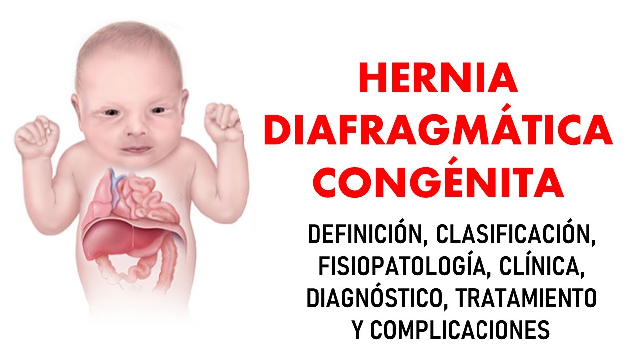 🔴 HERNIA DIAFRAGMÁTICA CONGÉNITA | Neonatología