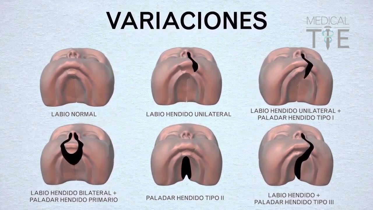 MEJOR VIDEO: LABIO LEPORINO Y PALADAR HENDIDO