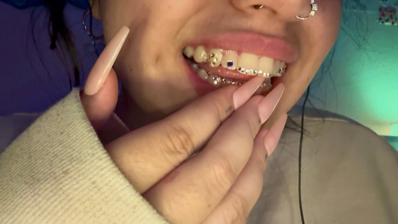 ASMR 𖦹⋆｡ teeth tapping on bedazzled retainer✨INTENSE AND UNPREDICTABLE,hand movements,mouth sounds