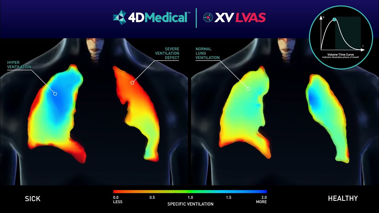 XV LVAS Lung Ventilation Comparison Video