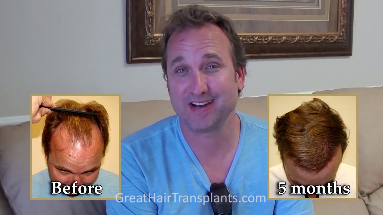 Best Hair Transplant & Restoration Techniques In Lehi, Utah - Dr. Brett Bolton