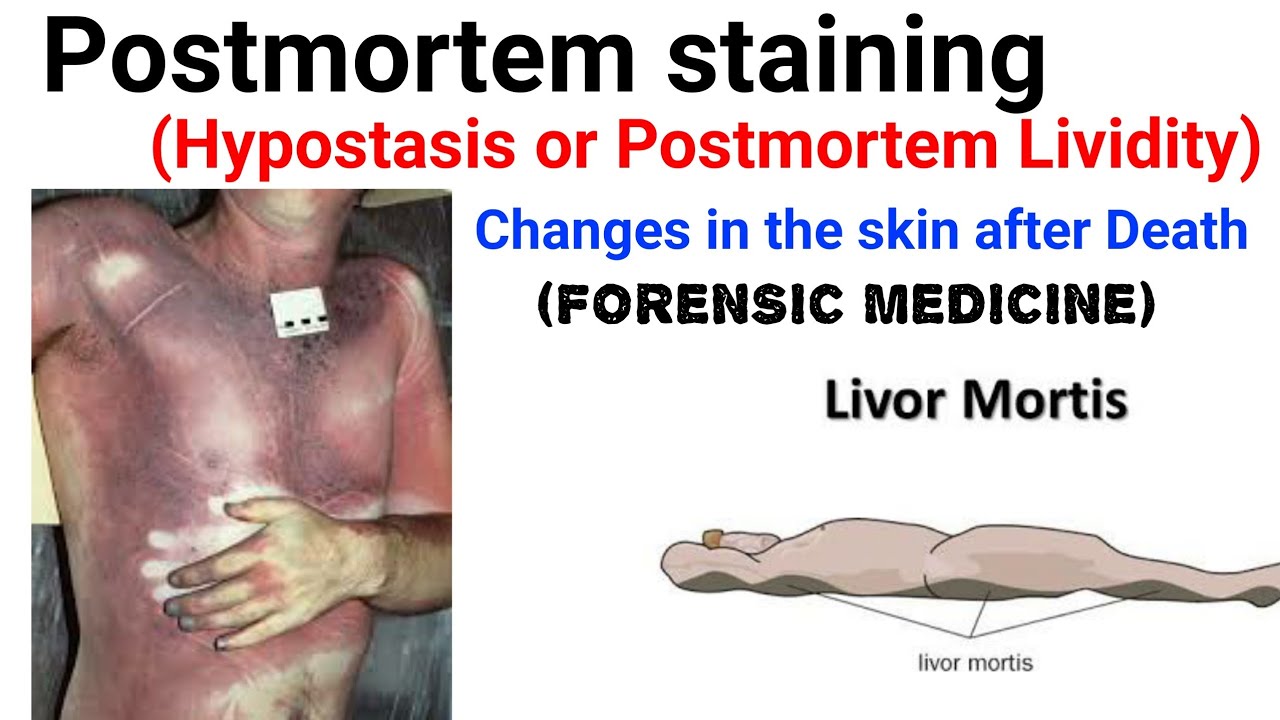 Postmortem Lividity | livor mortis | changes in the skin after death | Postmortem staining