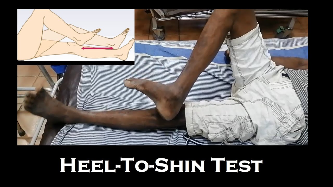 Heel-To-Shin test | Assesment of coordination