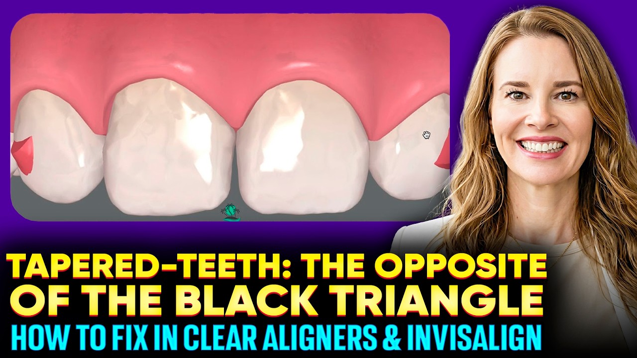 Not a Black Triangle! - So IPR Won't Work! Tapered Teeth and How to Address it in your Clincheck