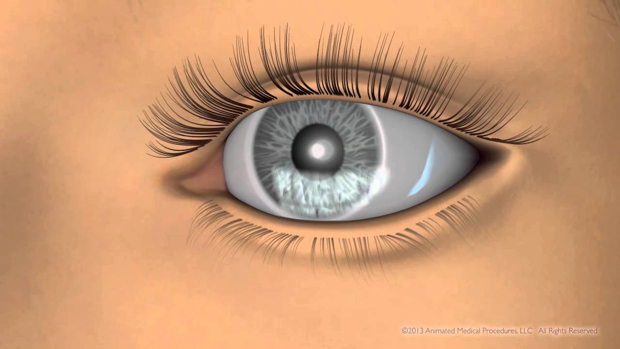 Tear Science LipiFlow Treatment at Mann Eye Institute