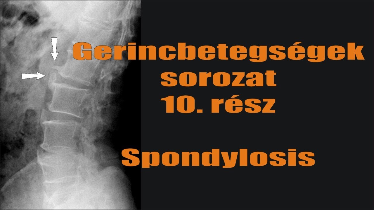 Gerincbetegségek sorozat 10. rész: Spondylosis